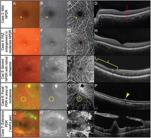 Figure 4. Manifestations of diabetic retinopathy. (Case 3) Mild non-proliferative diabetic retinopathy (NPDR) in the left eye of a 40 -year – old male. (A) Isolated microaneurysm present in the nasal macula (arrow) using colour fundus photography. (B) Improved visualisation of microaneurysm with the red-free filter (arrow). (C) 6 × 6 mm OCT-A superficial capillary slab (defined as inner limiting membrane to posterior inner plexiform layer) highlights the microaneurysm noted on fundus photography (yellow circle) and an additional microaneurysm (red circle). (D) No visual abnormalities can be seen on structural OCT in the region matching the additional microaneurysm (rectangle). (Case 4) Foveal avascular zone enlargement associated with moderate NPDR in the left eye of a 37-year-old male. (E) Several microaneurysms and intraretinal haemorrhages centrally evident with colour fundus photography (arrowheads). (F) Visualisation of diabetic lesions enhanced with red -free filter (arrowheads). (G) Enlargement of foveal avascular zone (dashed line) (6×6 mm OCT-A superficial slab). (H) No visual abnormalities present on horizontal structural OCT through the fovea. (Case 5) Retinal ischaemia associated with severe NPDR in a 31 -year -old male. (I) Colour fundus photography shows numerous microaneurysms and intraretinal haemorrhages centrally. (J) Red-free filter displays enhanced visualisation of diabetic lesions. (K) Reduced capillary perfusion (asterisk) consistent with retinal ischaemia temporally in 6 × 6 mm OCT-A superficial slab. (L) Focal inner retinal thinning (bracket) corresponding to the region of reduced superficial capillary perfusion visualised using structural OCT. (Case 6) Focal proliferative diabetic retinopathy (PDR) within a region of retinal ischaemia in a 43-year-old. (M) Small abnormal vessel in the inferior mid-periphery (circle) using fundus colour photography. (N) Green separation channel improves visualisation of abnormal vessel (circle). (O) Reduced capillary perfusion surrounding the abnormal vessel (circle) detected using 12 × 12 mm OCT-A superficial slab (user-defined vitreous space to posterior inner plexiform layer). (P) Pre-retinal hyper-reflective tissue (arrowhead) corresponding to the abnormal vessel consistent with pre-retinal neovascularisation on structural OCT. (Case 7) Extensive PDR in a 55-year-old male involving the retina and posterior vitreous. The neovascular complexes can form fibrovascular sheets generating a posterior pre-cortical vitreous pocket forming a ‘wolf’s jaw’ configuration. The ‘wolf’s jaw’ configuration is evident in this case, with superior and inferior fibrovascular tissue evident in ultra-widefield imaging (Q) red-green channels and (R) green separation channel imaging. (S) 12 × 12OCT-A superficial slab shows abnormal frond-like vascular networks in the regions of fibrosis. (T) Pre-retinal hyper-reflective sheets (asterisks) with associated retinal distortion on structural OCT.