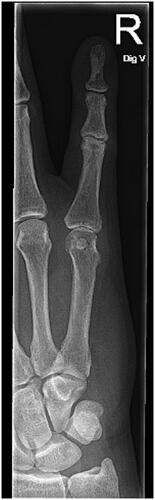 Figure 5. X ray of the right hand at follow-up (6.5 months).