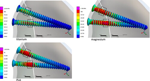 Figure 4. Comparison of the von Mises stress within the screws. Areas above the respective tensile strength are shown in purple for a) titanium, b) magnesium, and c) PLA screws.