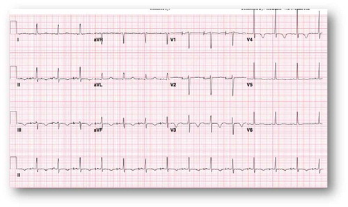 Figure 5. Atrial paced rhythm with non-specific T wave changes.