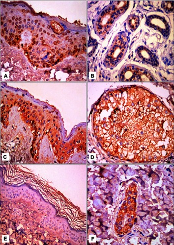 Figure 1 JAK1 immunohistochemical staining.