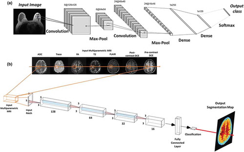 Figure 3. Illustration of convolutional neural architecture (CNN) architecture for classification of a radiological image for clinical diagnosis. (a) The CNN architecture shown here consists of two convolutional layers (each followed by a max-pooling layer), followed by two fully connected (dense) layers for image classification. (b) An example of a patch-based CNN applied to a multiparametric brain MRI dataset for segmentation of the different brain tissue types.