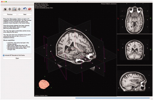 Figure 2. Scene generated by Tactics after importing preoperative images. The main view presents a volumetric representation of the data that can be observed by moving cross-sectional slices through the volume. The brain is automatically segmented from the images and is volumetrically rendered, as shown in the bottom left of the window. Fiducial markers of the stereotactic frame are identified as N-shaped fuchsia bars.