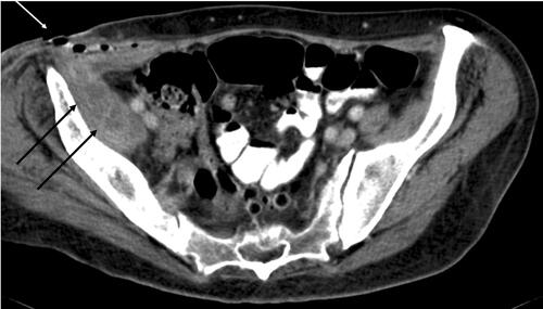 Figure 6 Multiple hypodense locules with the caudal fibres of the expanded right iliacus muscle (black arrows) representing an abscess arising from XGP in the right kidney (note the marked asymmetry with the normal left iliacus) (Elder & Malek Stage 3 disease). Bubbles of gas are shown in the right inguinal region at the site of multiple secondary cutaneous sinuses (white arrow). Contrast is also visible within the sinuses following contrast sinography.