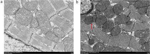 Figure 3. Mitochondrion morphology observed by TEM. The ultrastructure changes of the 15 min-ligation mitochondria are depicted in Figure 3. (a) Sham group; (b) acute MI group: dissolution of the outer membrane (red arrow), the ruptured or disappeared cristae (black arrow). The magnification is 10 000. Scale bar = 1 μm.