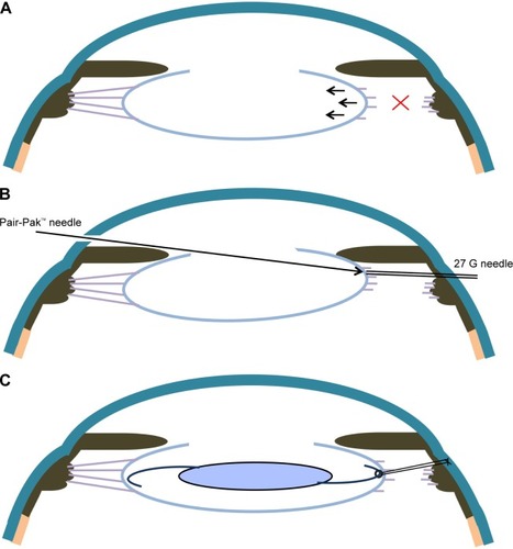 Figure 2 (A) Zinn’s zonule dialysis is observed in the right side. (B) The straight needle of Pair-Pak passes through the path of the 27 G needle, it pierces the equatoria segment. (C) At the end of the surgery, the unilateral IOL loop is fixed with a 10-0 polypropylene thread from the scleral flap.