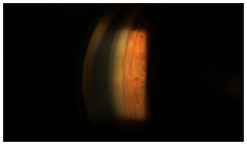 Figure 1 With conventional gonioscopy, the angle appears occluded.