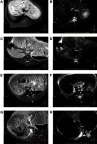 Figure 2 PVTTs were observed in TW1s and TW2s in four groups. (A-B) showed PVTTs (arrow) in TW1s and TW2s of group A. (C-D) showed PVTTs (arrow) in TW1s and TW2s of group B. (E-F) showed PVTTs (arrow) in TW1s and TW2s of group C. (G-H) showed PVTTs (arrow) in TW1s and TW2s of group D. The SI of PVTTs in rabbits of groups A and B were significantly lower than that in rabbits of groups C and D in TW2s.