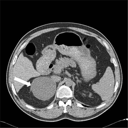 Figure 1. Abdominal computed tomography (CT) shows a regular homogeneous right adrenal mass measuring 8.5 × 7.5 × 7 cm, with attenuation of 20 HU (arrow).