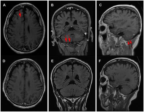 Figure 3 (A) Brain MRI detected abnormal enhancement in the brain (red arrows) and (B and C) leptomeningeal linear enhancement (red arrows) in the cerebellar hemisphere; (D) brain MRI showed that the abnormal enhancement in the brain and (E and F) the leptomeningeal linear enhancement in the cerebellar hemisphere had disappeared.