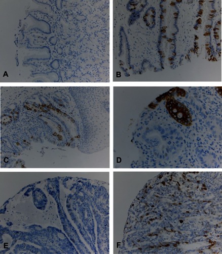 Figure 4 MUC2 immunohistochemical study (IHC) in esophageal tissue microarray (TMA). (A) Columnar cell metaplasia with negative MUC2 immunostain; (B) Barrett’s esophagus with positive MUC2 immunostain; (C) Low-grade dysplasia with positive MUC2 immunostain; (D) High-grade dysplasia with positive MUC2 immunostain; (E) Esophageal adenocarcinoma with negative MUC2 immunostain; (F) Esophageal adenocarcinoma with positive MUC2 immunostain.