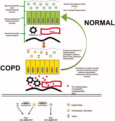 Figure 1. Schematic representation of the changes in microbiota and inflammation in COPD patients. Top, airway mucosa of healthy subjects presents a normal muco-microbiotic layer characterized by eubacteria. In contrast, in COPD patients, the muco-microbiotic layer is altered by pathogenic bacteria and viruses, which are associated with an inflammatory state of the bronchial-bronchiolar mucosa (epithelium and lamina propria). As a hypothesis, administration of probiotics may ameliorate the histopathological features of the airways, contributing to restoring a normal homeostasis in the lung. Bottom, the scheme shows that: (1) eubacteria have anti-inflammatory effects; (2) pathogenetic bacteria and viruses have pro-inflammatory effects; (3) eubacteria and pathogenic bacteria show antagonist actions; (4) pathogenic bacteria and viruses show agonist-challenging and pro-inflammatory actions.