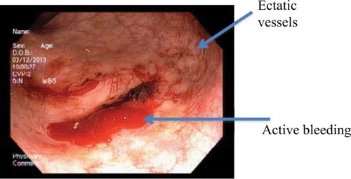 Figure 5 Chronic radiation proctitis showing telangiectasia (case 3).