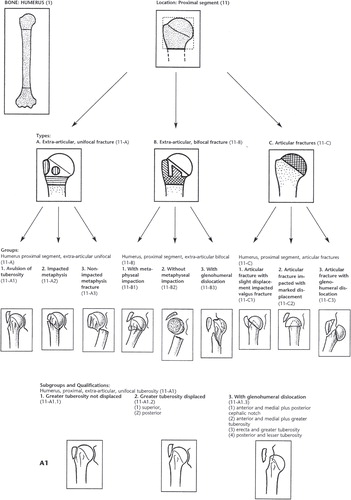 Figure 2. The AO/OTA classification consists of three types, nine groups, and 27 subgroups hierarchically organized according to prognosis. Type A fractures are unifocal and extraarticular, type B are bifocal and extraarticular while type C fractures are intraarticular. Reprinted from Marsh (Citation2007) 19 with permission from J Orthop Trauma, Copyright Clearance Center.