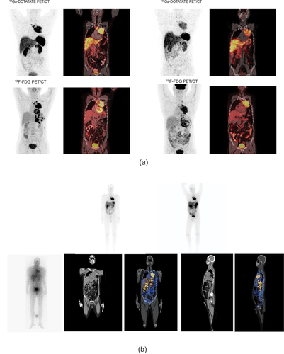 Figure 12. Mediastinal NET on Chemo-PRRT. (a) the baseline (left sided panel) dual tracer PET imaging (68Ga-DOTATATE PET/CT on top and 18F-FDG PET/CT in the lower panel) showed SSTR expressing (Krennings score 3) and FDG avid mediastinal mass, nodes, pleural deposits and duodenal lesions . He received 3# of 177LuDOTATATE PRRT (cumulative dose: 559 mCi), and 1 cycle of 90Y-DOTATATE with dose of 102 mCi and CAPTEM of 8 cycles. He got symptomatically better, breathlessness got reduced. His Sr. chromogranin a was reduced to 520 ng/ml from 1440 ng/ml. His post therapy response evaluation dual tracer PET (right sided panel) showed some reduction in size and number of SSTR expressing and FDG avid lesions, rest of lesions showed stable disease. (b) the upper panel shows post-177Lu-DOTATATE therapy planar gamma camera images, while bottom panel is showing 90Y-Bremsstrahlung planar gamma camera and SPECT/CT fused and corresponding plain CT images.