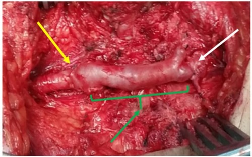 Figure 4 Left saphenous vein interposition graft (green arrow) anastomosed to the left common femoral artery (white arrow) and its bifurcation (yellow arrow).