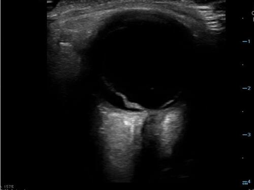 Figure 2 Point of care ultrasound image of retinal detachment.