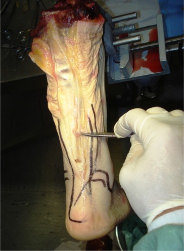Figure 9 Cadaveric dissection of the Achilles tendon (AT). Sural nerve lies at the lateral border of the AT.