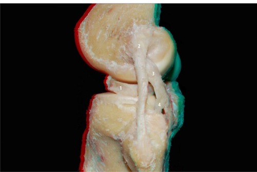 Figure 3 Lateral view of the posterolateral compartment of the extended knee: lateral meniscus (1), lateral collateral ligament (2), popliteus tendon (3), and popliteofibular ligament (4).