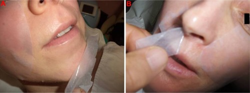 Figure 2 Good adhesiveness of Betesil® patch to the skin and ease of removal (A and B).