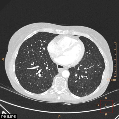 Figure 2. HRCT case I