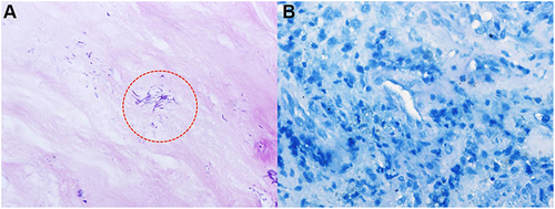 Figure 4 In postoperative pathology, Brucella (red circle) was positive for Giemsa staining (A). Mycobacterium tuberculosis was negative for acid-fast staining of the intervertebral disc of L4/5 (B).