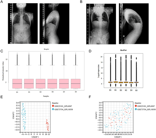 Figure 2 Sample collection and processing: (A) Full spine lateral radiograph of the control group. (B) Full spine lateral radiograph of a patient with AS-KD. (C and D) Normalization and log transformation were applied to the ceRNA sequencing data of ISL samples from AS-KD patients (D: disease group; H: healthy group). (E) Gene expression data from PB samples of AS patients before batch correction. (F) Gene expression data from PB samples of AS patients after batch correction.