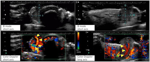 Figure 2. Ultrasound findings. B-mode images revealed a well-defined hypoechoic region seen protruding from the subcutis to the outside of the body. Color doppler images showed pulsatile vascular inflow from deep within the lesion (arrowhead).