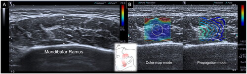 Figure 1. Ultrasound imaging for thickness (A) and stiffness (B) measurements of the masseter muscle. White dashed line, maximal muscle thickness.