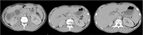Figure 1 A 17-year-old male with pain in the right upper abdomen.