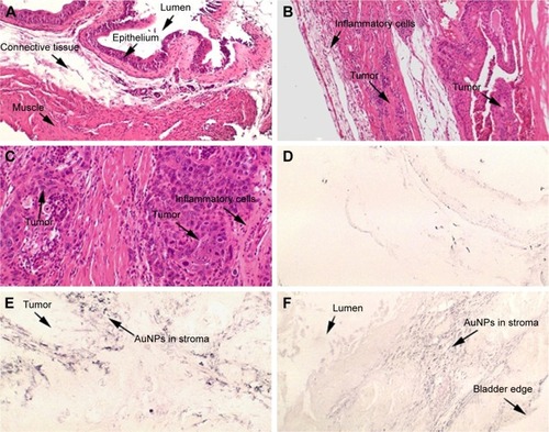 Figure 1 (A) Normal bladder without BBN treatment or AuNPs at 40×. (B) High-grade muscle-invasive bladder cancer induced by BBN presenting at 22 weeks at 40× and (C) at 200×. (D) Gold enhanced normal bladder without BBN treatment or AuNPs at 40× illustrates average level of background noise from gold enhancement. (E) AuNPs aggregating in the stroma surrounding tumor cells. (F) AuNPs deposit all the way out to the outer edge of the bladder enveloping tumor masses.Abbreviations: AuNPs, gold nanoparticles; BBN, N-butyl-N-(4-hydroxybutyl)nitrosamine.