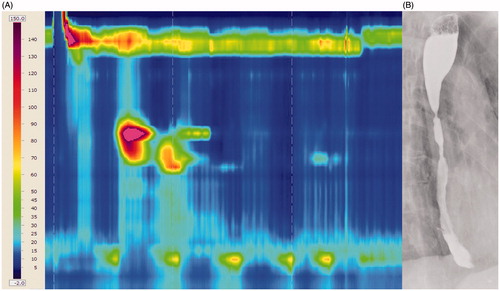 Figure 3. High-resolution manometry (A) and barium esophagogram (B) three months after POEM procedure. Proximal to the myotomy a small segment with hypertensive and spastic contractions is still present on the high-resolution manometry. The barium esophagogram confirms this by showing a proximal prestenotic dilation. These findings explain the cause of high dysphagia the patient still experienced after treatment.