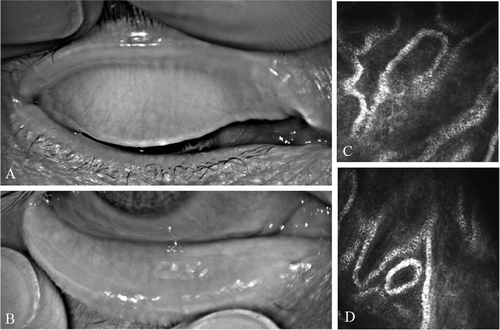 Figure 1. A 50-year-old male patient with severe obstructive MGD. The meibography examination (A: meibography image of upper eyelid; B: meibography image of lower eyelid) showed that the MGs of this patient were vague and difficult to identify in both the upper and lower eyelids; the acinar units were extremely enlarged as seen with confocal microscopy (C, D: confocal microscope images of meibomian acinar structure in upper eyelid).