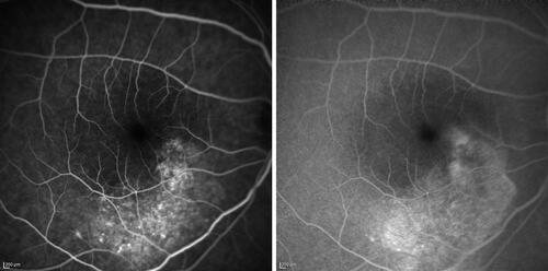 Figure 3 Early and late fluorescein angiograms of a 29-year-old patient affected by chronic central serous chorio-retinopathy revealing an irregularity of the retinal pigment epithelium, resembling a “honeycomb” pattern, near the point of fluorescein leakage. Window defects and late-phase leakage from the expanding point in the superior macula are evident, toward the fovea in a “steam” configuration.