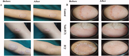 Figure 4. (A) Photographic photos of control, void, effective aspasomal cream (FC2′) before and after treatment in TC. (B) Dermoscopic picture before treatment showed the presence of circinate erythematous scaly lesions with elevated raised border TC, and its disappearance after treatment indicates the efficacy of aspasomes encapsulated ITZ cream FC2′.