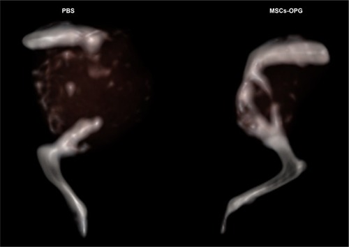 Figure 7 Representative CT scanning image of osteosarcoma.