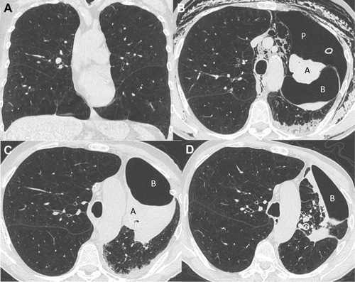 Figure 4 Chest CT evolution (patient 4). (A) Baseline chest CT characterized by homogeneous emphysema. (B) Chest CT performed 7 days after valves insertion in the left upper lobe (LUL). We can see a complete atelectasis (A) of the LUL, a pneumothorax (P) of the left lung, pneumomediastinum, subcutaneous emphysema, chest tube drainage and a bulla (B) with air–liquid level. (C) Chest CT performed 26 days after valves insertion showing resolution of the air leak, bulla (B) with air–liquid level, the atelectasis (A) of the LUL and left lower lobe (LLL) infiltrates. (D) Chest CT performed 100 days after valves insertion characterized by resolution of the air leak and decreased size of the bulla (B) (always with air–liquid level) as well as the LLL infiltrates.