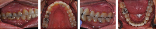 Figure 1. Dry oral mucosa, extensive cervical caries on posterior maxillary and mandibular dentitions and dry, erythematous palatal tissue.