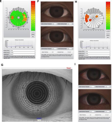 Figure 1 OSA patients with different presentations of TF-scan and R-scan. A 32-year-old female patient with an AHI of 10.9 had TMH of 0.19 mm (A), NIKBUT Level 0, and First NIKBUT of 18.54 seconds on TF-scan (B), the scores of R scan showed 1.1 for the nasal-bulbar area, 0.6 for the temporal-bulbar area, 0.9 for the nasal-limbal area, and 0.4 for the temporal-limbal area (C). A 30-year-old male patient with an AHI of 17.7 had TMH of 0.18 mm (D), NIKBUT Level 1, and First NIKBUT of 7.65 seconds on TF-scan (E), the scores of R scan showed 1.0 for the nasal-bulbar area, 0.9 for the temporal-bulbar area, 0.9 for the nasal-limbal area, and 0.9 for the temporal-limbal area (F). A 35 year-old male patient with an AHI of 72.2 had TMH of 0.11 mm (G), NIKBUT Level 2, and First NIKBUT of 3.63 seconds on TF-scan (H), The scores of R scan showed 1.8 for the nasal-bulbar area, 2.1 for the temporal-bulbar area, 1.3 for the nasal-limbal area, and 1.0 for the temporal-limbal area (I).