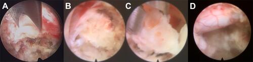 Figure 3 Intraoperative views. (A) The intervertebral foramen was remolded with a endoscopic osteotome. (B) After secondary molding, the calcified disc pressing on the nerve root was exposed. (C) Calcified discs were removed in fragments. (D) After decompression, the nerve roots showed good pulsation.