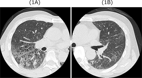 Figure 1 (A and B) Chest high resolution computed tomography findings on admission revealed bilateral diffuse ground glass opacities in all lung lobes with traction bronchiectasis.