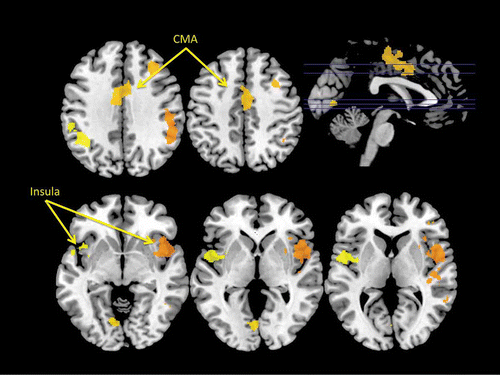 Figure 4. Regions exhibiting a statistically significant increase in blood oxygen level-dependent (BOLD) signal corresponding to the self-reported urge to yawn in an fMRI study of yawning. Again this analysis revealed statistically significant foci of activation within the insular cortex and the dorsal mid-cingulate cortex. CMA: cingulate motor area.