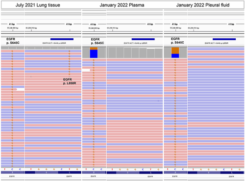 Figure 2 EGFR S645C and EGFR L858R detected in lung tissue (July 2021), plasma (January 2022) and pleural fluid (January 2022).