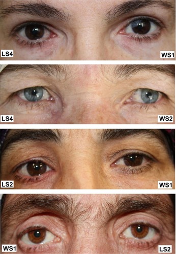 Figure 2 Appearance of patients graded according to the evaluation performed by the first ophthalmologist.