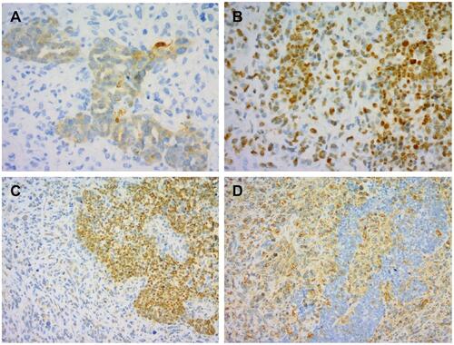 Figure 1 Typical images of immunohistochemical staining. AE1/AE3, p53 and WT-1 positivity was noted in the epithelioid area by EnVision (A–C), and Vim-1 was positive in the spindle cell area (D).