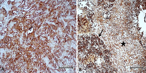 Figure 1. HEG1 expression in malignant mesothelioma subtypes. (A) Strong HEG1 expression in high-grade epithelioid malignant mesothelioma (immunoperoxidase, 100X). (B) Biphasic mesothelioma; strong HEG1 expression (arrow) in epithelioid areas, weak HEG1 expression (star) in sarcomatoid areas (immunoperoxidase, 100X). Scale bar = 500 µm.
