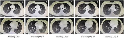 Figure 3. Changes in chest CT findings in patients with paraquat poisoning during FPSA-CVVH treatment. (A) The right lung and the lower lobe of the left lung were scattered in spots and small patches of ground glass density shadows, and the boundary was unclear; (B) The lung inflammatory shadow progressed compared with that on the 1st day; (C) The lung inflammatory shadow was slightly absorbed compared with that on the third day; (D) The lungs were scattered with little inflammatory shadow; (E) No abnormalities were found on chest CT.