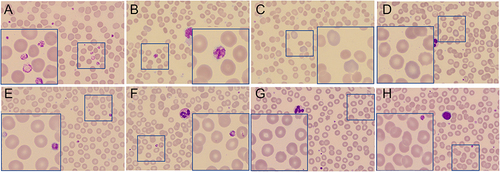 Figure 4 Dynamic morphological change in peripheral blood of COIVD-19 subjects. (A–D) Peripheral blood smears of T1 and T2 stage, showing anisocytosis and nonhomogeneous platelets. (A) Large platelets with the anomaly of α granules distribution; (B) large platelet; (C) polychromatic erythrocyte; (D) anisocytosis. (E–H) showing fewer anisocytosis and normal size platelet and large platelet. (E) Large platelet; (F) normal platelet; (G) homogeneous erythrocyte; (H) homogeneous erythrocyte and normal platelet. The large blue squares are the local magnification of the small ones. (Wright-Giemsa stain, Overall magnification×40, local magnification×100).