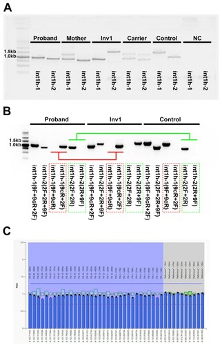 Figure 2. The aberrant patterns of Inv1 in a 1-year-old boy with severe HA. A, The int1h-1 is amplified using int1h-1 specific primers (9F, 9cR) and the int1h-2 specific primer 2F, while the int1h-2 is amplified using int1h-2 specific primers (2F and 2R) and the primer 9F. The boy showed similar int1h-1 band with Inv1 patient, while had similar int1h-2 band with healthy control. His mother had similar int1h-1 bands with Inv1 carrier, while had similar int1h-2 band with healthy control. B, The int1h-1 was amplified in three PCR tubes including different primers, 9F+9cR+2F, 9F+9cR (for wild type sequence), and 9cR+2F (for Inv1 sequence). The int1h-2 was amplified in three PCR tubes including different primers, 2F+2R+9F, 2F+2R (for wild type sequence), and 2R+9F (for Inv1 sequence). The boy showed same pattern of int1h-1 with Inv1 patient, but had same pattern of int1h-2 with healthy control. This result confirmed the presence of inversed int1h-1. C, MLPA was performed to detect duplication and deletion within the exonic regions of the F8 gene. The ratio between 0.75 and 1.25 was considered as normal.