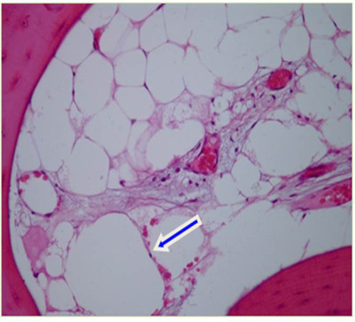 Figure 2 Micrograph of a sample of FDOJ showing osteonecrosis and necrobiotic adipocyte degeneration.